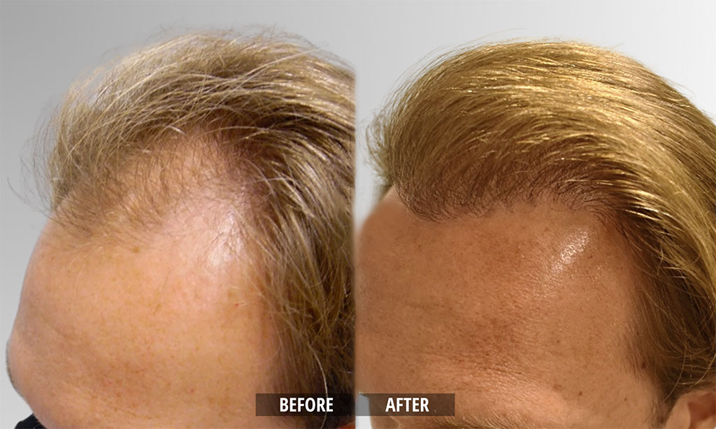 Hair Growth Roll-On Serum – See hair growth in 4 weeks