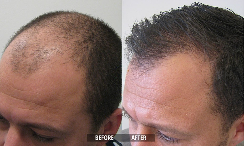Hair Growth Roll-On Serum – See hair growth in 4 weeks