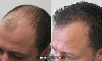 Hair Growth Roll-On Serum – See hair growth in 4 weeks